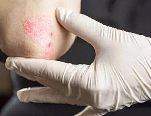 Die 20 besten Mittel gegen Psoriasis