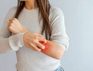 Die 10 besten Mittel gegen Dermatitis mit iHerb